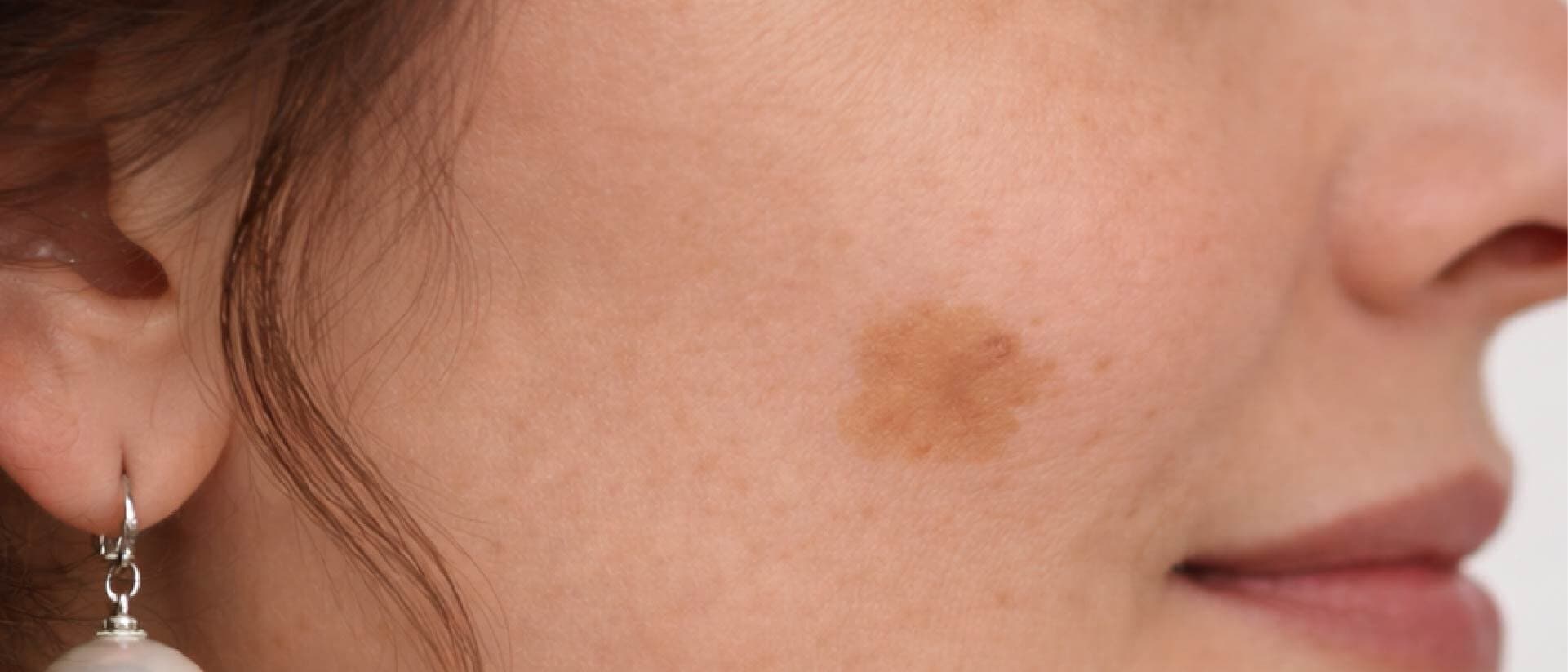 IPL Mancha localizada