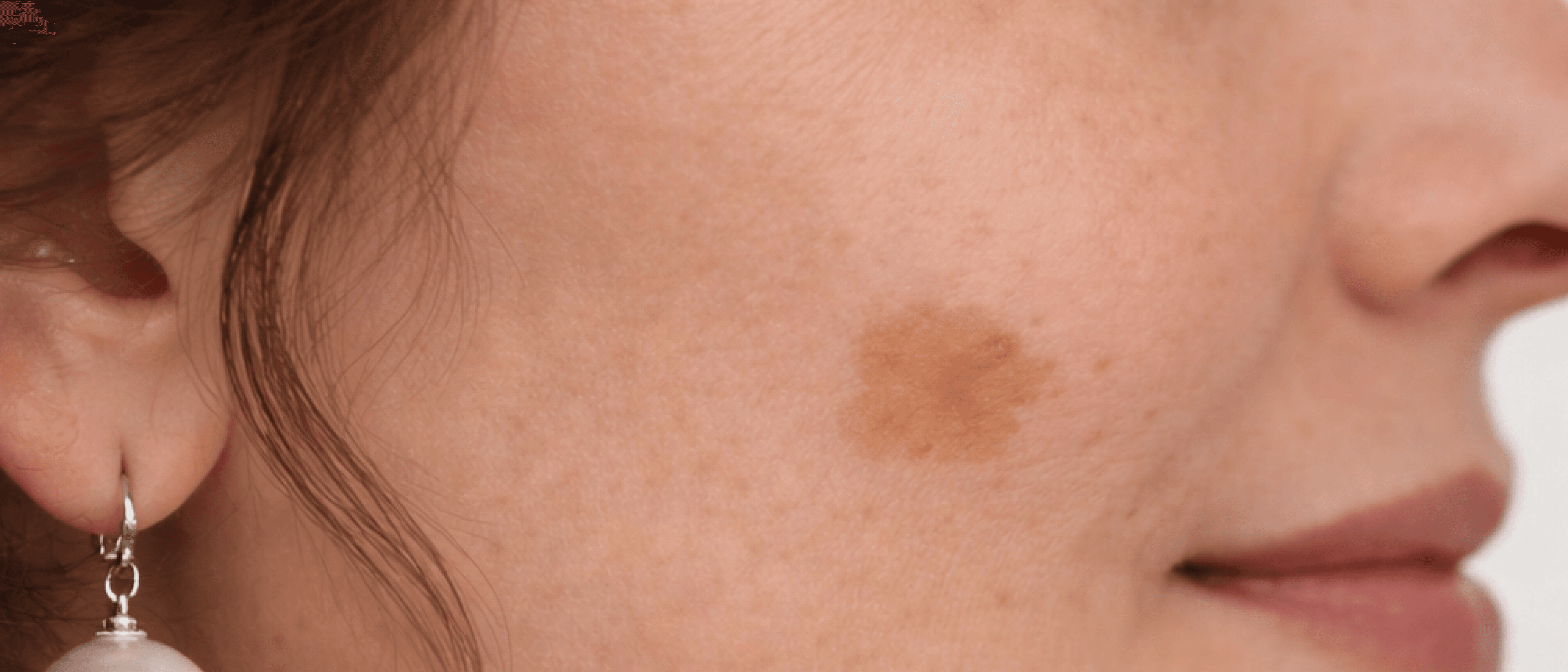 IPL Mancha localizada