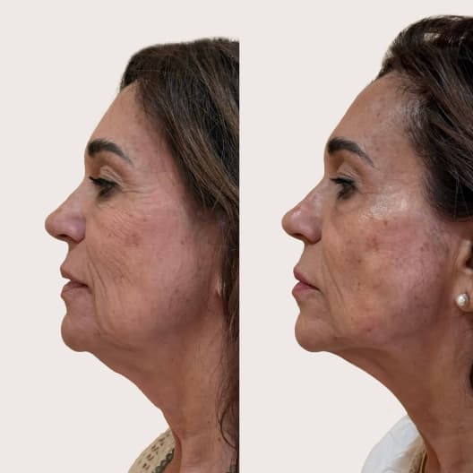 antes y despues Armonización facial