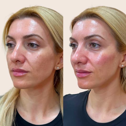 antes y despues Armonización facial