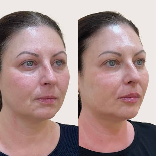 antes y despues Armonización facial