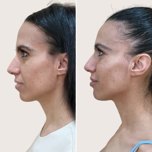 antes y despues Armonización facial