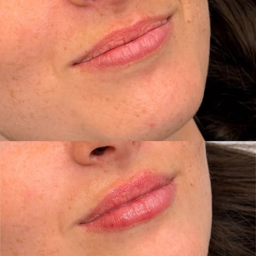antes y despues Aumento de labios