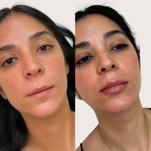 antes y despues Aumento de labios