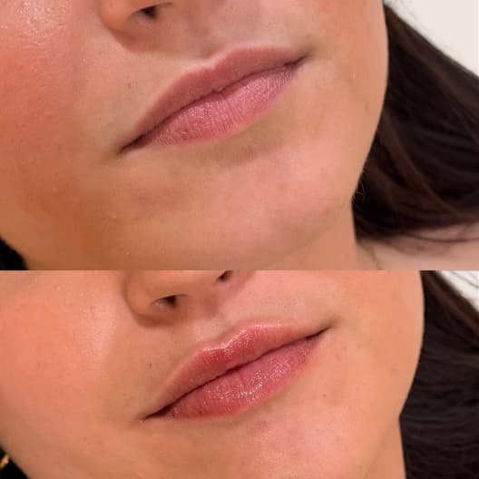 antes y despues Aumento de labios