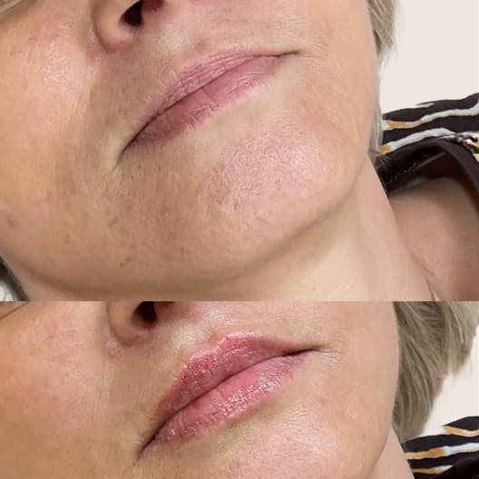 antes y despues Aumento de labios