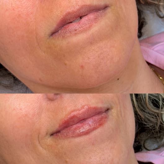 antes y despues Aumento de labios