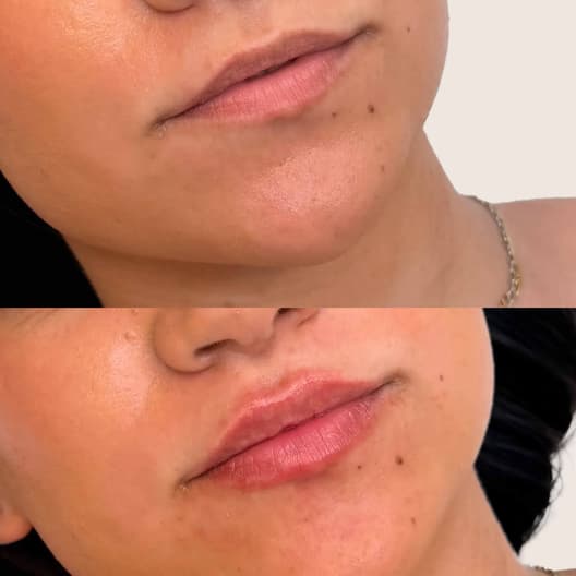 antes y despues Aumento de labios