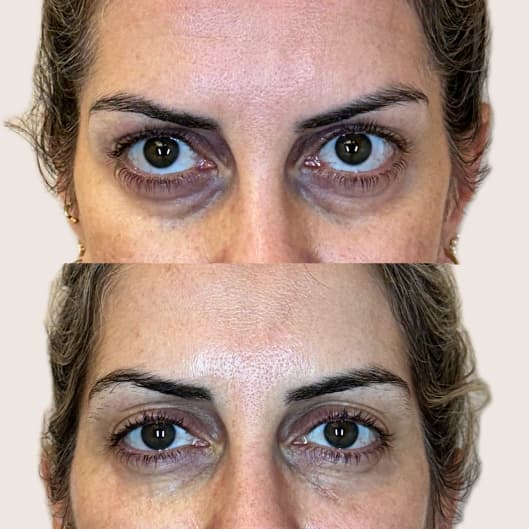 antes y despues Relleno de ojeras