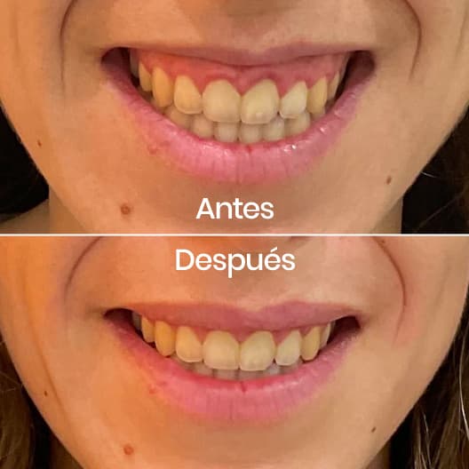 Sonrisa gingival antes y después - Resultado 3 - Holaglow