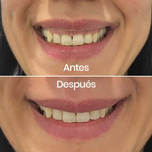 Sonrisa gingival antes y después - Resultado 4 - Holaglow