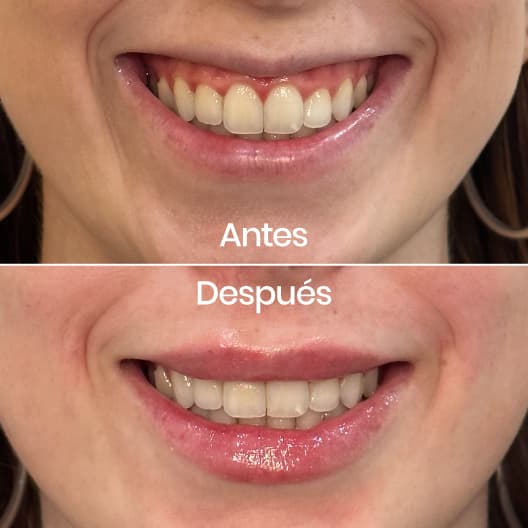 Sonrisa gingival antes y después - Resultado 2 - Holaglow