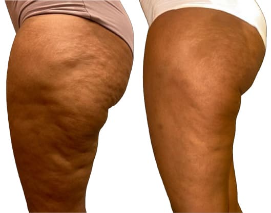 Alidya Anticelulítico antes y después - Resultado 1 - Holaglow