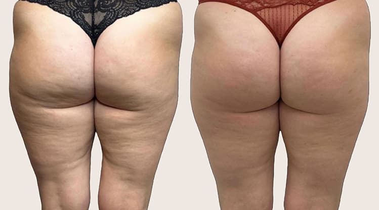 Alidya Anticelulítico antes y después - Resultado 4 - Holaglow