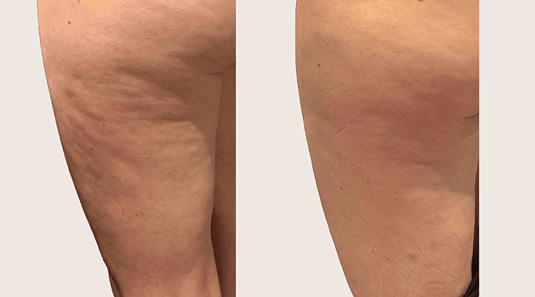 Alidya Anticelulítico antes y después - Resultado 2 - Holaglow