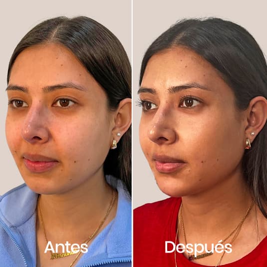 Armonización facial Basic antes y después - Resultado 2 - Holaglow