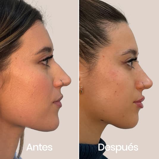 Armonización facial Basic antes y después - Resultado 1 - Holaglow