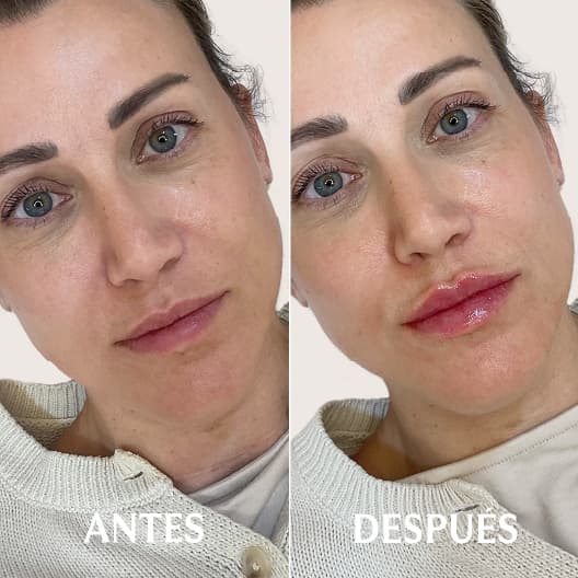 Aumento de labios antes y después - Resultado 6 - Holaglow