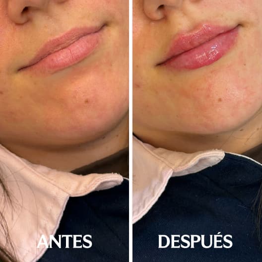 Aumento de labios antes y después - Resultado 8 - Holaglow