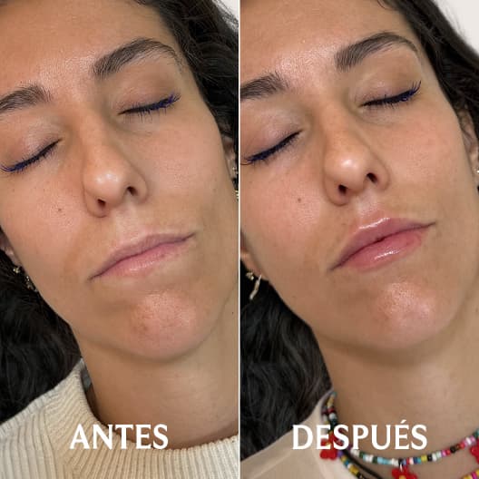 Aumento de labios antes y después - Resultado 7 - Holaglow