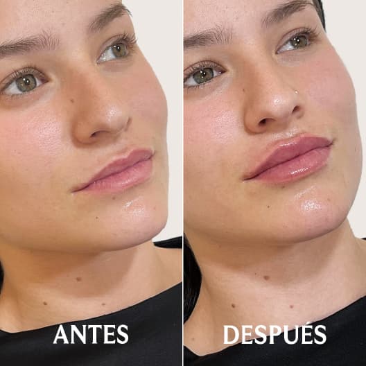 Aumento de labios antes y después - Resultado 10 - Holaglow