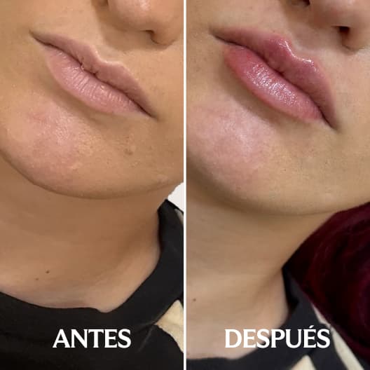 Aumento de labios antes y después - Resultado 5 - Holaglow