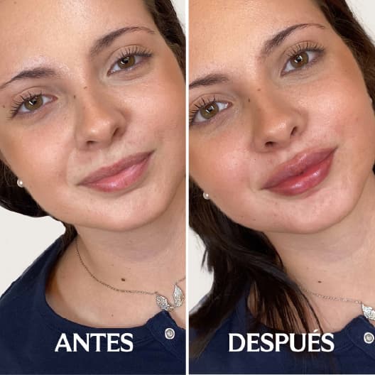 Aumento de labios antes y después - Resultado 9 - Holaglow