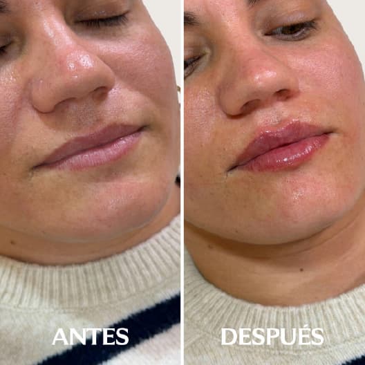 Aumento de labios antes y después - Resultado 2 - Holaglow