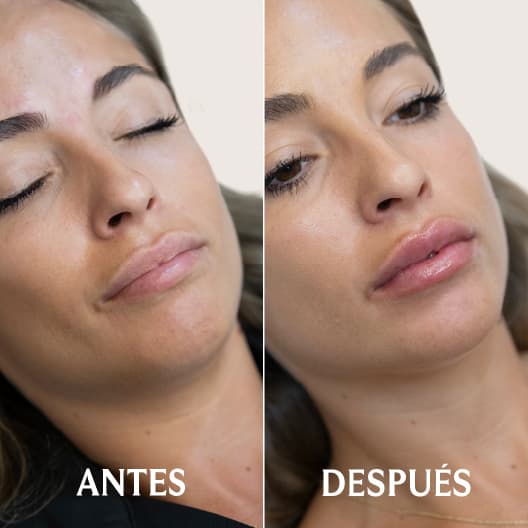 Aumento de labios antes y después - Resultado 4 - Holaglow