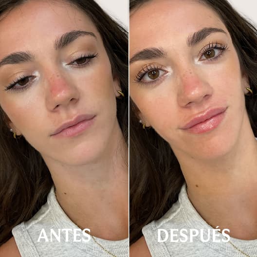 Aumento de labios antes y después - Resultado 1 - Holaglow