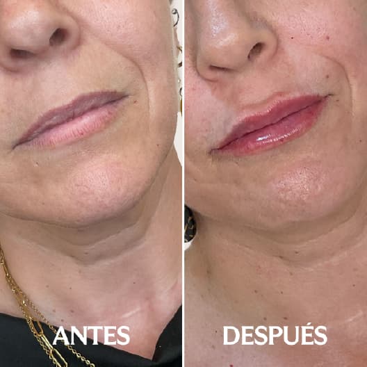 Aumento de labios antes y después - Resultado 3 - Holaglow
