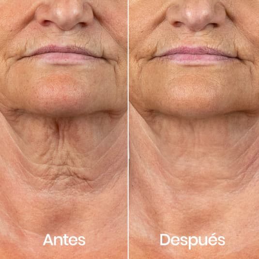 Hilos tensores cuello antes y después - Resultado 1 - Holaglow
