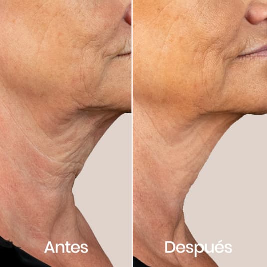 Hilos tensores cuello antes y después - Resultado 2 - Holaglow