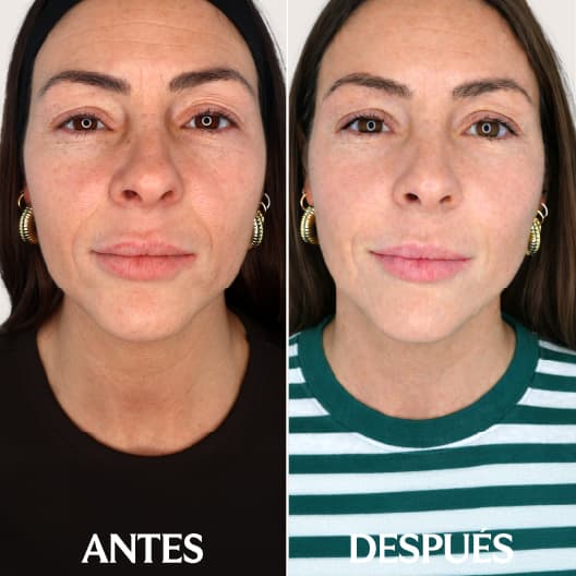 IPL Rejuvenecimiento antes y después - Resultado 1 - Holaglow