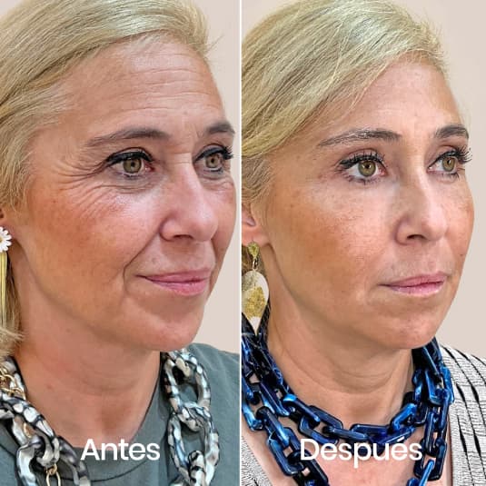 Full Face antes y después - Resultado 5 - Holaglow
