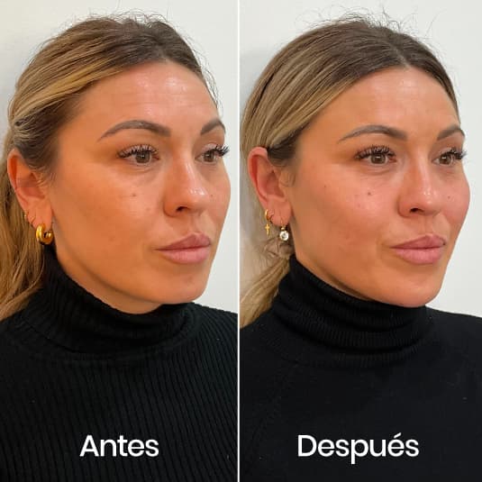 Full Face antes y después - Resultado 3 - Holaglow