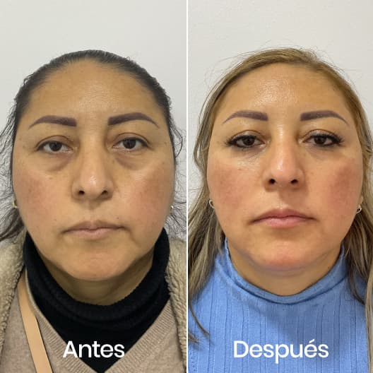 Full Face antes y después - Resultado 2 - Holaglow