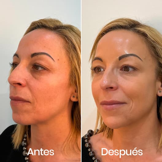 Full Face antes y después - Resultado 1 - Holaglow