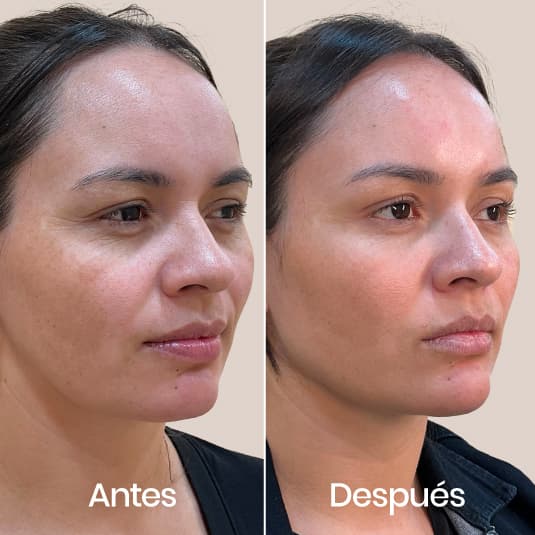 Pack Wellaging antes y después - Resultado 2 - Holaglow