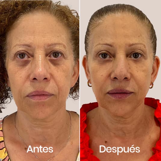 Pack Wellaging antes y después - Resultado 3 - Holaglow