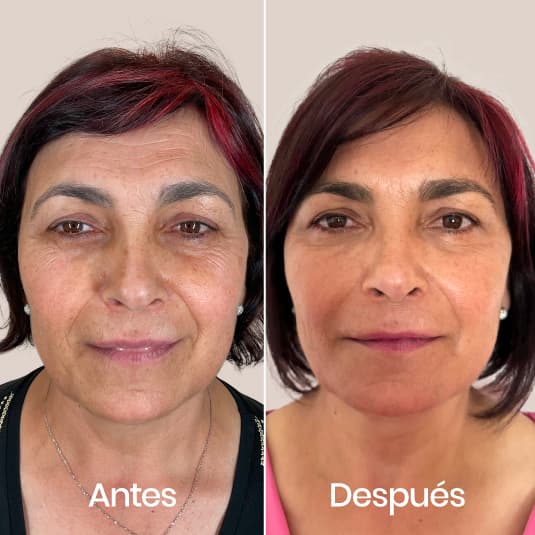 Pack Wellaging antes y después - Resultado 1 - Holaglow