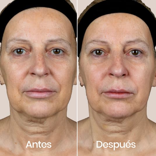 Polinucleotidos antes y después - Resultado 2 - Holaglow