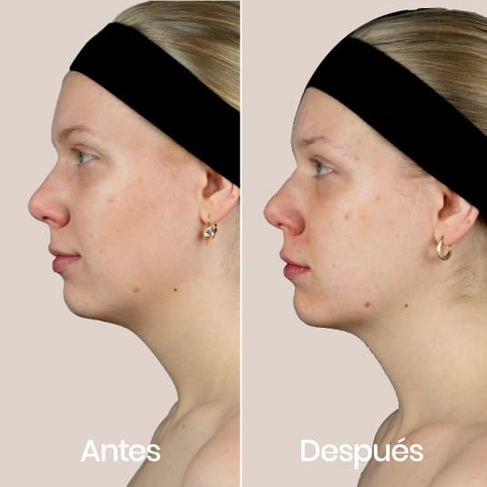 Polinucleotidos antes y después - Resultado 1 - Holaglow
