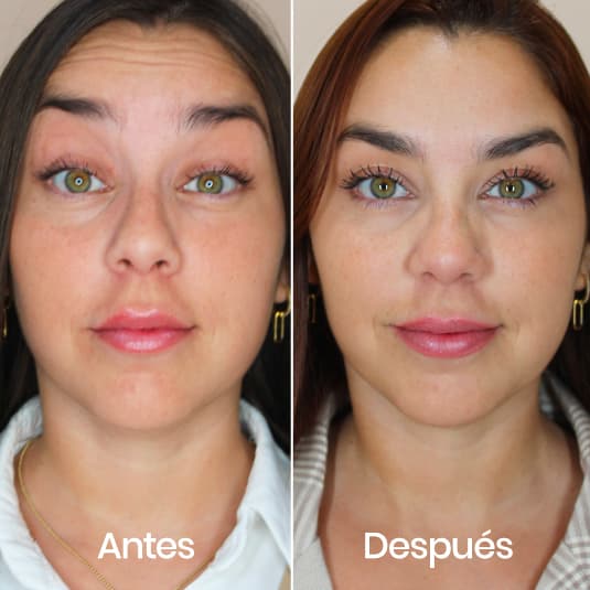 Prevención de arrugas antes y después - Resultado 1 - Holaglow