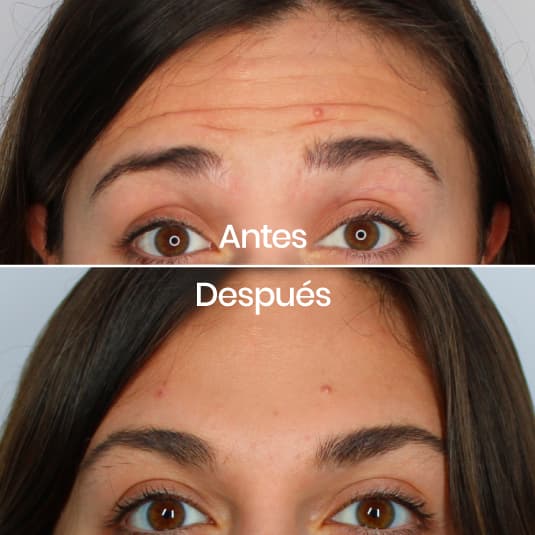 Prevención de arrugas antes y después - Resultado 2 - Holaglow
