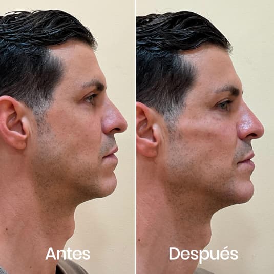 Marcación mandibular antes y después - Resultado 5 - Holaglow