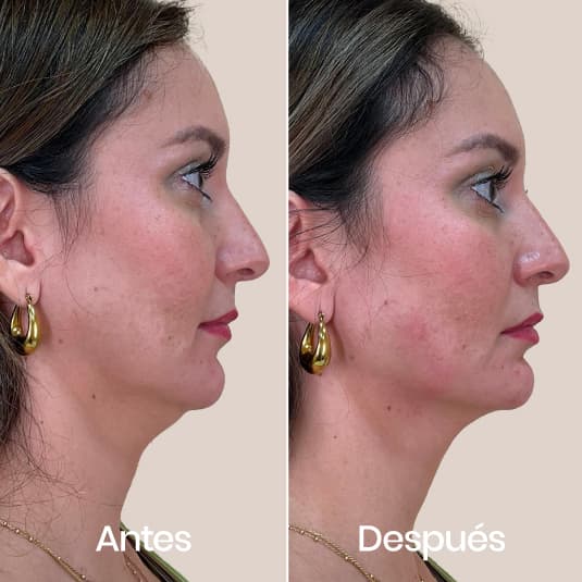 Marcación mandibular antes y después - Resultado 3 - Holaglow