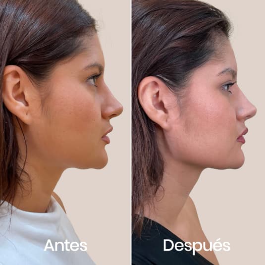 Marcación mandibular antes y después - Resultado 4 - Holaglow
