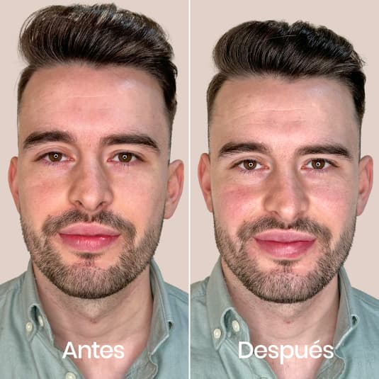 Marcación mandibular antes y después - Resultado 7 - Holaglow