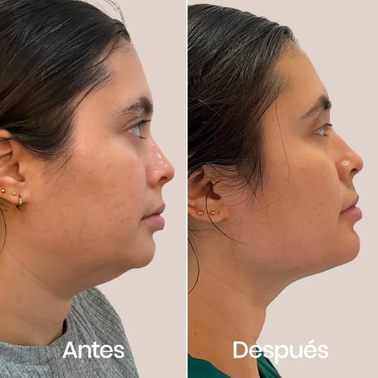 Marcación mandibular antes y después - Resultado 6 - Holaglow